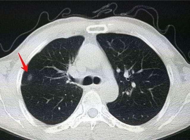 肺上有结节是怎么回事，肺结节是怎么回事图1
