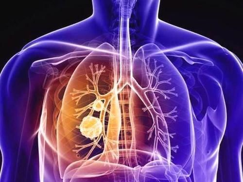 肺上有结节是怎么回事，肺结节是怎么回事图3