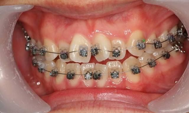 牙齿深覆合:孩子几岁是牙齿正畸的最佳时机图14