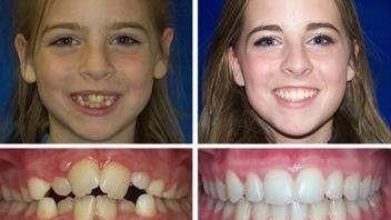 牙齿深覆合:孩子几岁是牙齿正畸的最佳时机图17