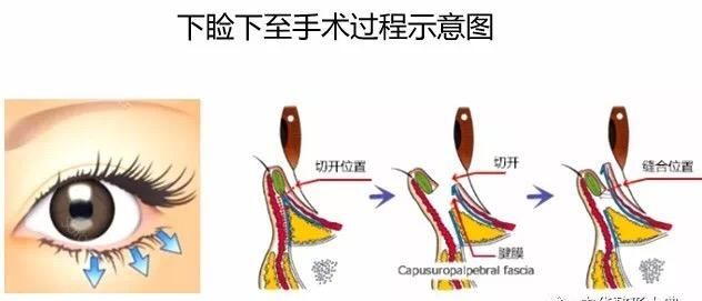 眼部整形手术的费用,眼部整形都包括哪些图5