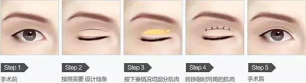 做开眼角哪好:割了双眼皮和开眼角要多久恢复好图6