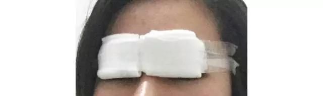 做开眼角哪好:割了双眼皮和开眼角要多久恢复好图19