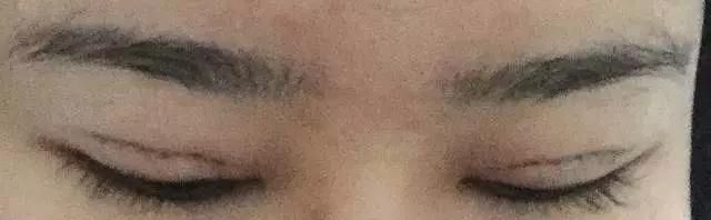 做开眼角哪好:割了双眼皮和开眼角要多久恢复好图25