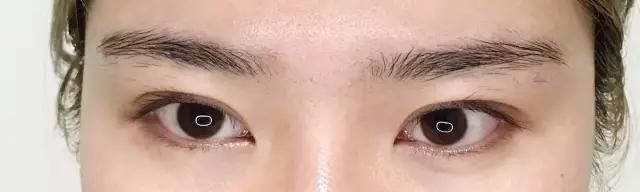 做开眼角哪好:割了双眼皮和开眼角要多久恢复好图38