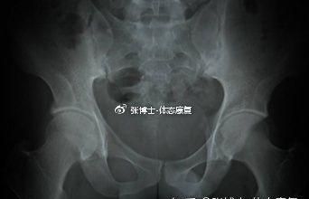 强直性脊柱炎 运动：强直性脊柱炎要怎么锻炼图3