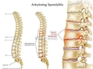 强直性脊柱炎 运动：强直性脊柱炎要怎么锻炼图4