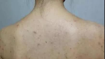 脸部长痘对应五脏的图:脸上长了痤疮怎么办如何调理可以快速消图9