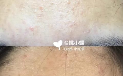 闭口长什么样子:额头长满闭口怎么办