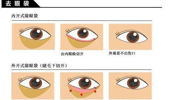 电波拉皮去眼袋,眼袋严重下垂，用什么方法能解决图1