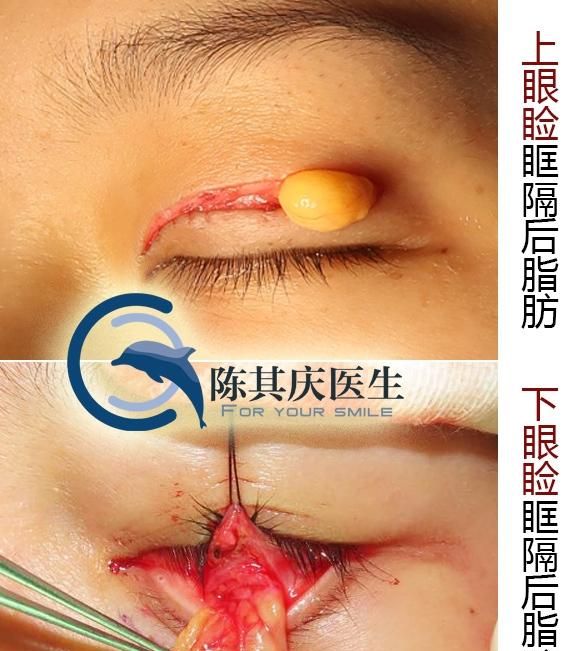 上眼皮抽脂手术:眼睑抽脂需要几天可以恢复图1