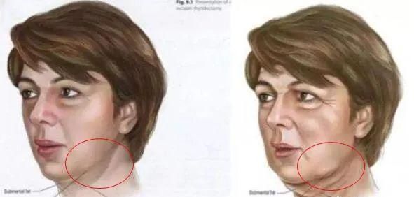 面部下垂提升术，如何改善脸部的下垂和法令纹图1