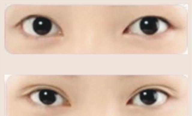 垫鼻子的副作用：你能接受女友或者你妈割双眼皮、垫鼻梁图1