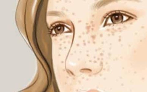 黄褐斑如何治疗,黄褐斑怎么治疗最好
