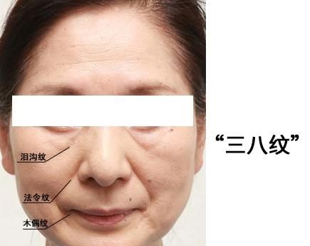 消除法令纹最好的方法，要怎么样才能去除法令纹和木偶纹呢，有没有什么好方法图1