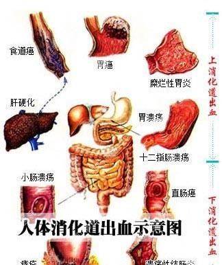 怎么区分痔疮出血和肠道出血：胃出血还是肠出血该如何判定图3