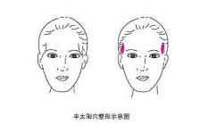 太阳穴填充手术:太阳穴填充术怎么做图1