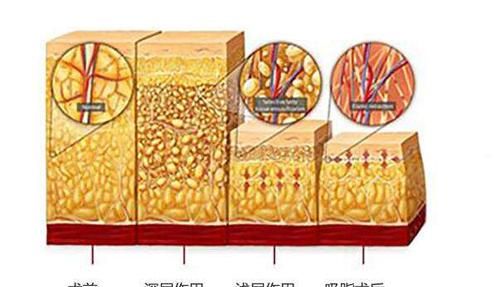 抽脂减肥的副作用：抽脂减肥的危害有哪些图3