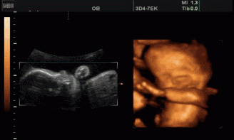 怀孕三个月的胎儿图，怀孕5个月的胎儿是什么样子的呢孕妇怎样保养好身体呢图1