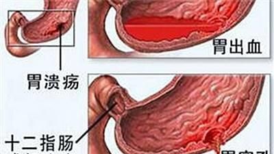 胃镜的适应症,胃镜检查适用于哪些病症图6