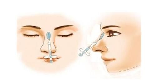 玻尿酸隆鼻尖:玻尿酸注射隆鼻可以对于鼻头鼻尖注射吗图1
