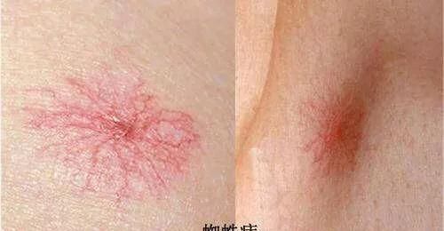 蜘蛛痣图片，长了两个蜘蛛痣严重吗图3