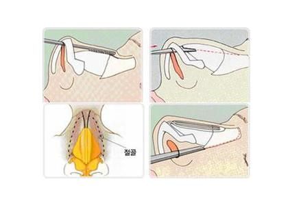 驼峰鼻多少钱，驼峰鼻整形风险图2