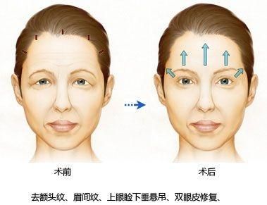 额头抬头纹，额头有抬头纹好吗图3