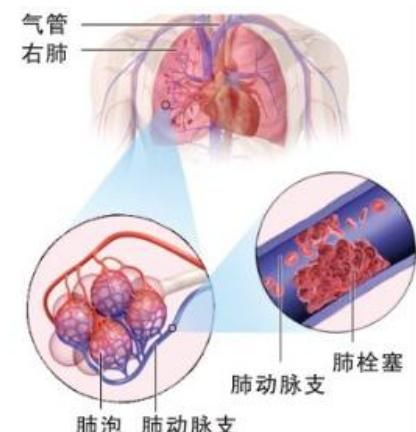 抽脂减肥方法，抽脂减肥的风险图8