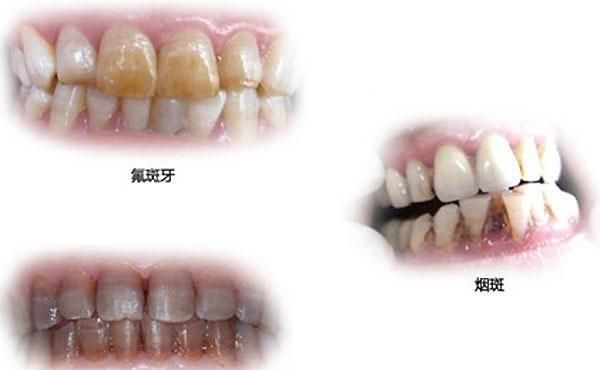花生美白牙齿，嚼花生刷牙真的可以美白牙齿吗图3