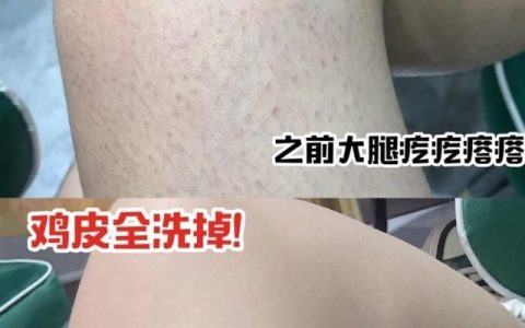 毛囊角质化