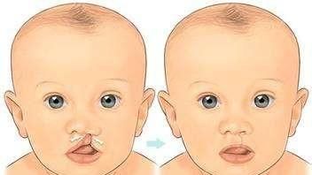 唇腭裂图片，先天性唇腭裂是什么原因导致的图3