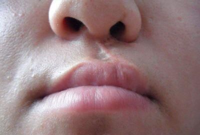 唇腭裂图片，先天性唇腭裂是什么原因导致的图6