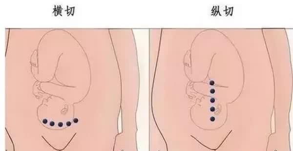 剖宫产中横切口好还是竖切口好，有什么不同，哪个更利于产后恢复如何护理伤口图1