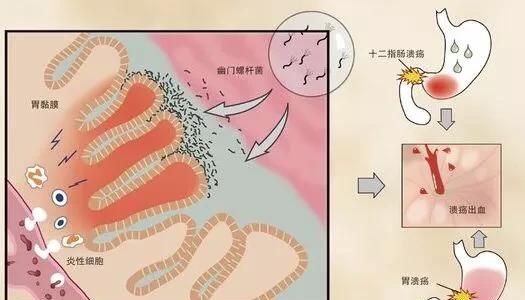 十二指肠癌，十二指肠球部溃疡能变成癌吗图5