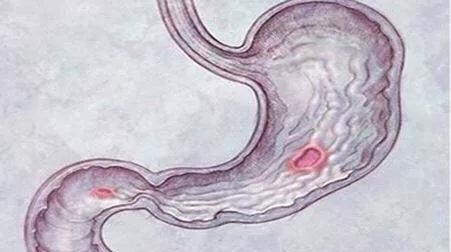 十二指肠癌，十二指肠球部溃疡能变成癌吗图6