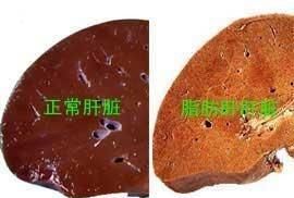 脂肪肝饮食，中度脂肪肝饮食注意什么图1