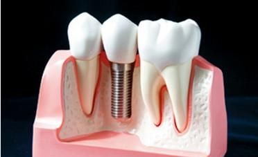 种牙有哪些危害，做种植牙对身体有哪些要求图4