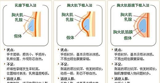 隆胸用什么材料最好图4