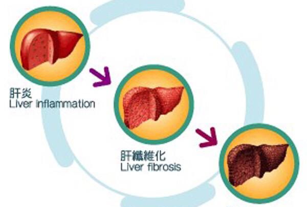 肝功能不正常的表现，肝功能不正常说明什么问题图2