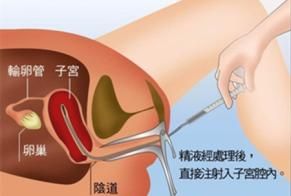 人工授精的成功率，做完人工授精怎样才能增加成功率图1