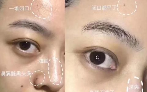光子嫩肤祛痘印效果好吗