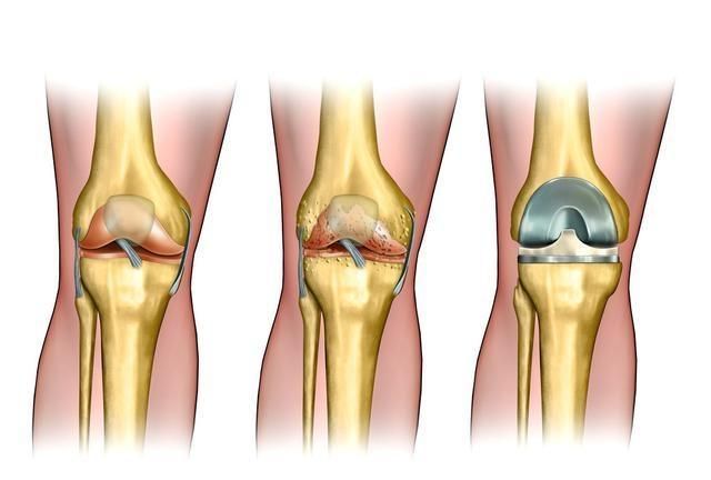 关节感染，关节置换手术后感染的原因图1