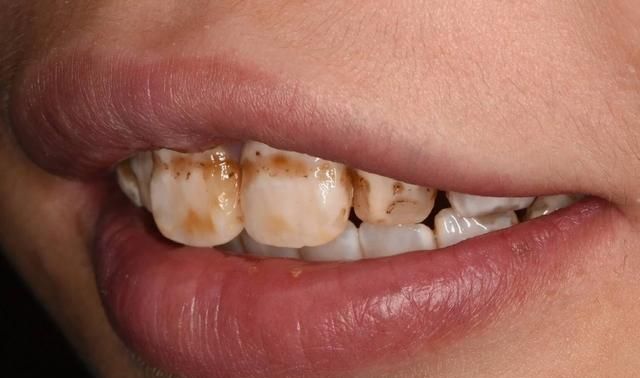 去除黄牙、牙结石、黑牙、牙垢，用牙粉和牙膏刷牙，哪个效果好图1
