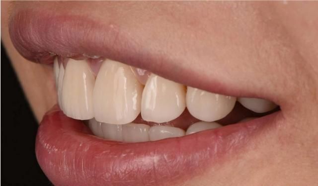 去除黄牙、牙结石、黑牙、牙垢，用牙粉和牙膏刷牙，哪个效果好图2