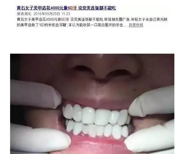 牙贴面好不好，牙齿贴面和牙齿美白哪个更好图13