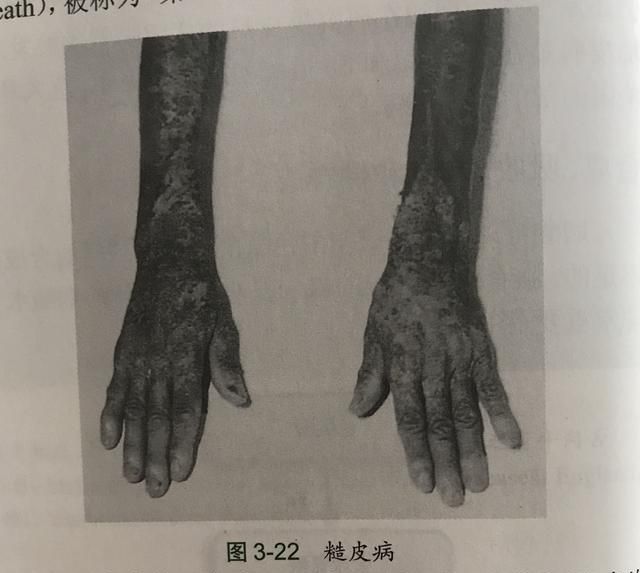 皮肤特别干燥是缺什么，皮肤干燥嘴唇干裂缺少什么维生素图2
