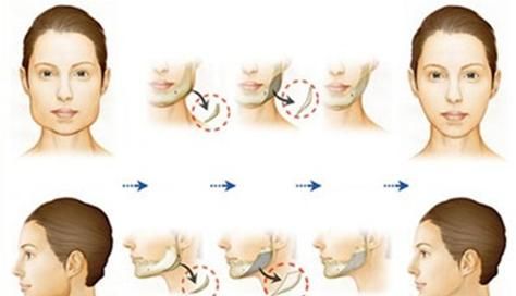 下颌角后遗症，下颌角手术以后会有后遗症吗图2