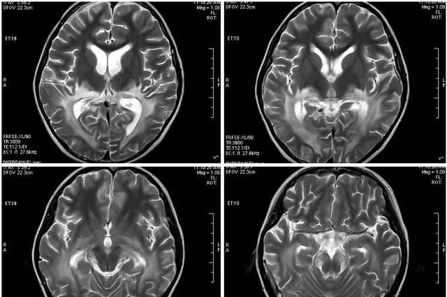 脑白质营养不良，肾上腺脑白质营养不良的症状图1