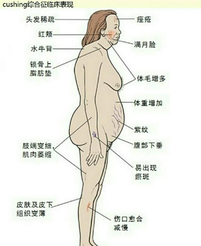 脑垂体微腺瘤，垂体微腺瘤是癌症吗图3